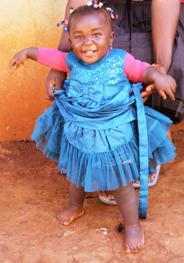 A-child-treated-of-clubfoot